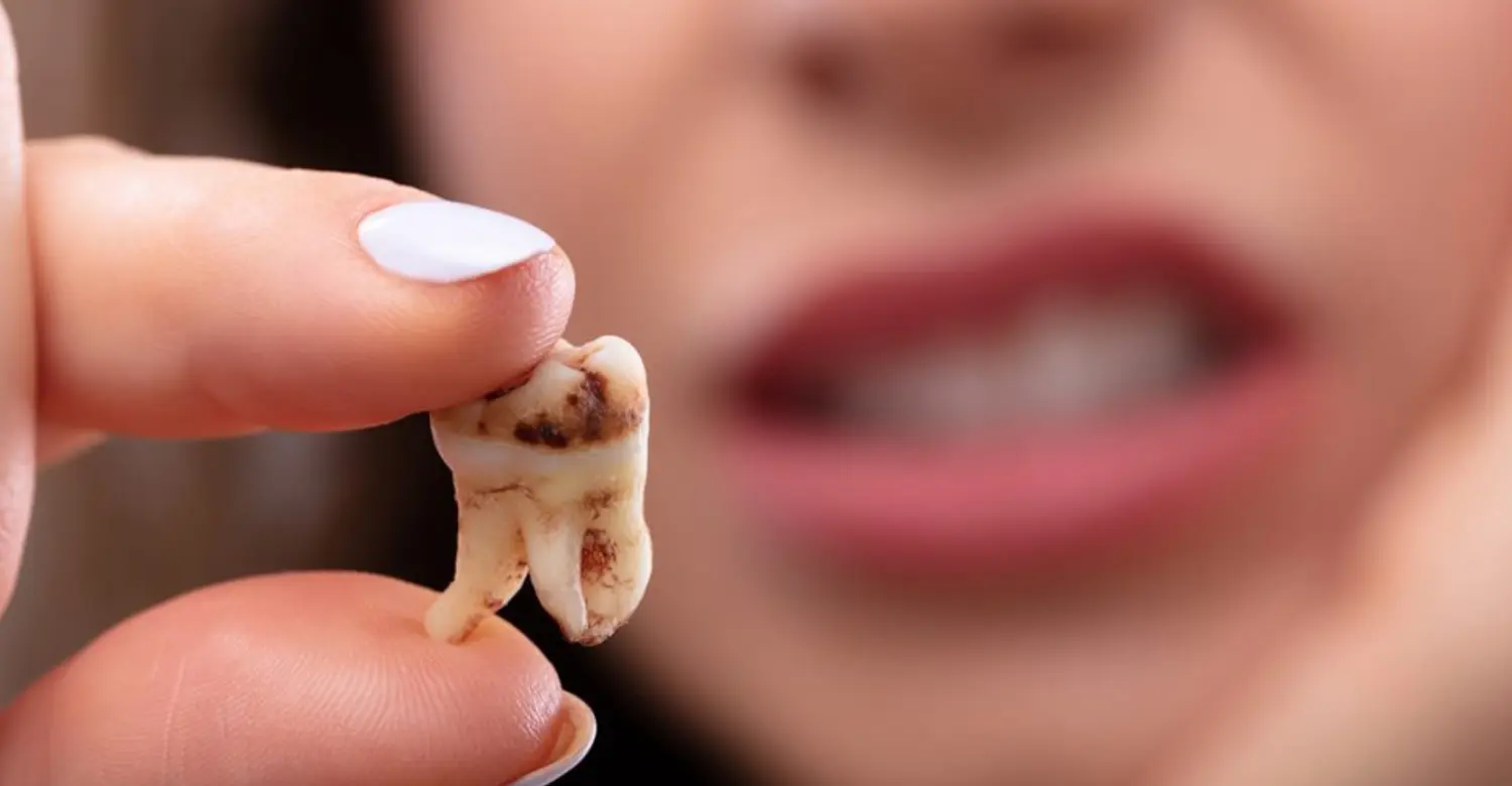 Causes of Tooth Decay 2